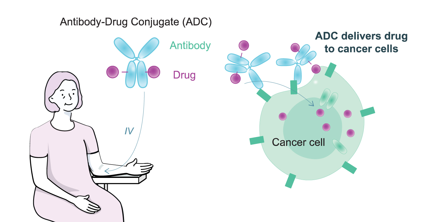 Illustration showing a woman receiving Antibody Drug Conjugate (ADC) through an IV. ADC delivers drug to cancer cells.