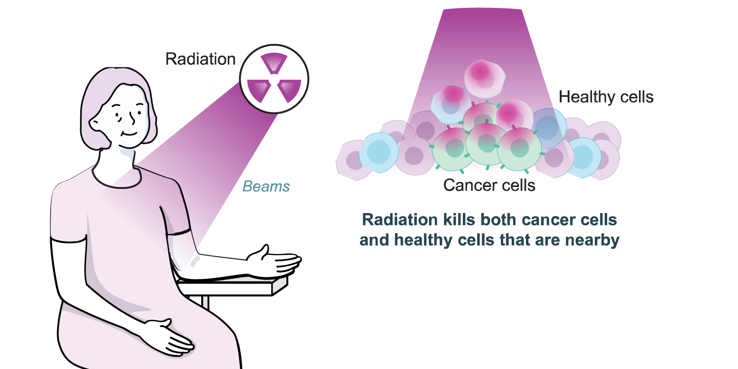 Illustration showing a woman receiving Radiation therapy. Radiation kills both cancer cells and healthy cells that are nearby.
