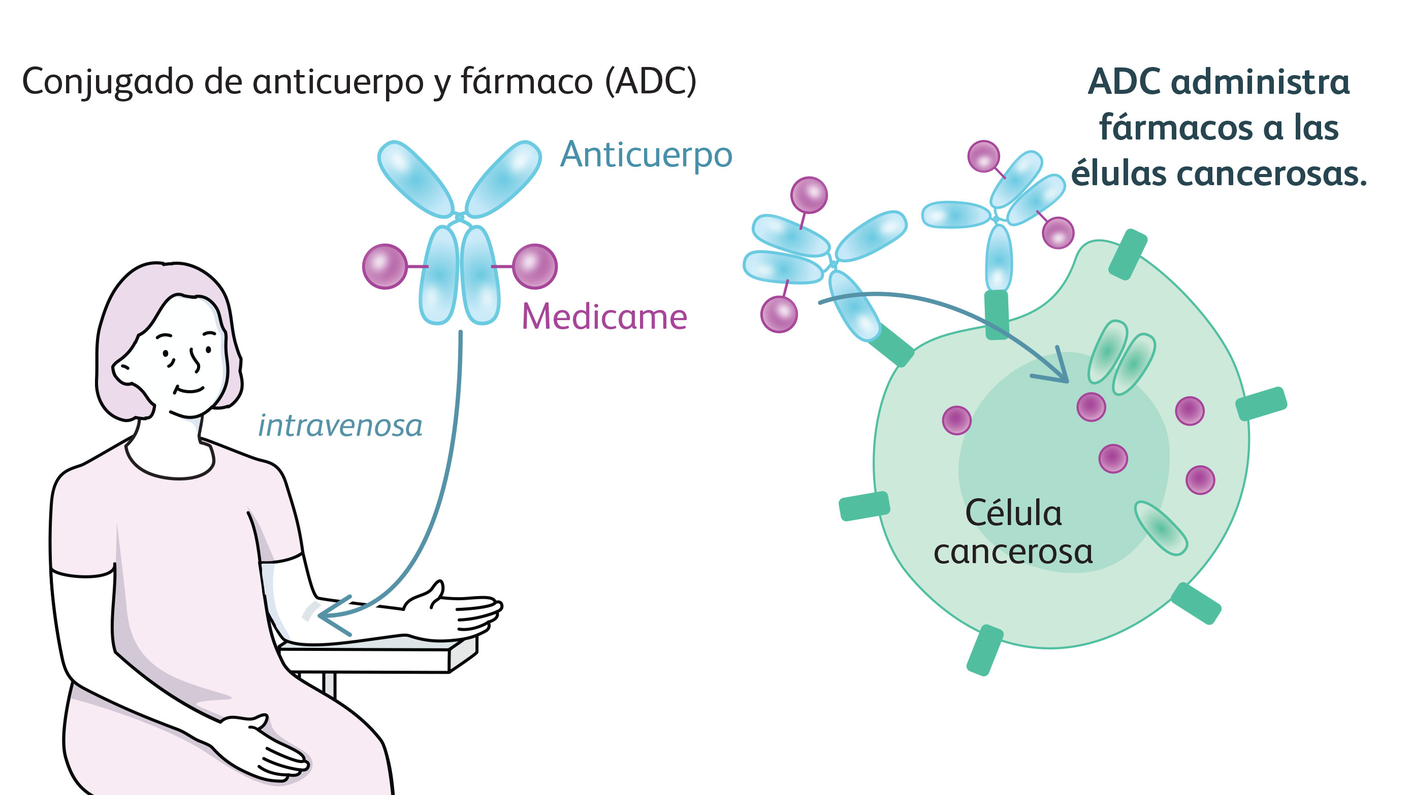 Ilustración que muestra a una mujer recibiendo un conjugado de fármaco y anticuerpo (ADC) por vía intravenosa. El ADC administra el fármaco a las células cancerosas.