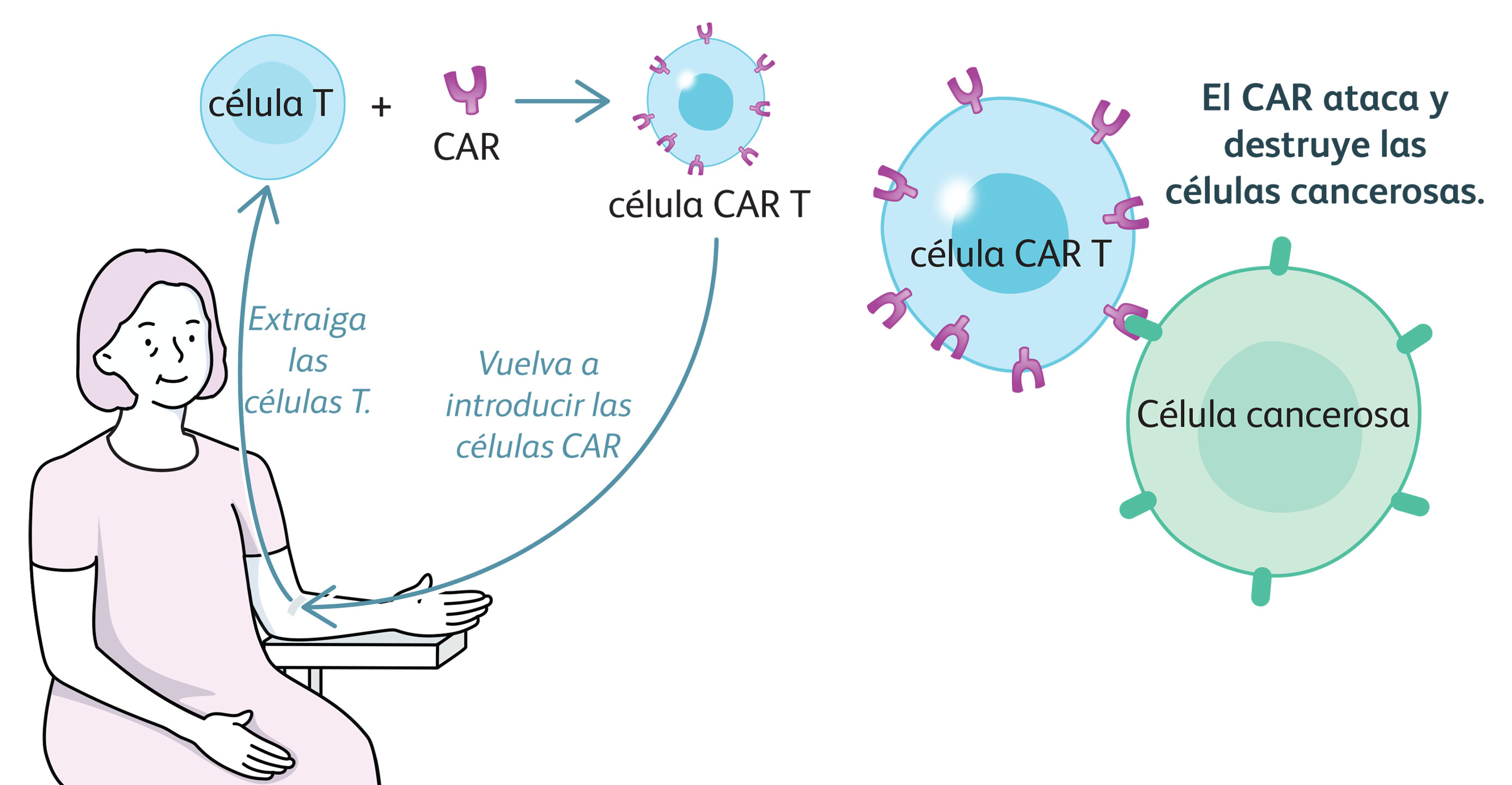 Ilustración que muestra a una mujer recibiendo terapia con células CAR-T: se extraen las células T, se combinan con CAR y se reintroducen como células CAR-T dirigidas contra las células cancerosas.