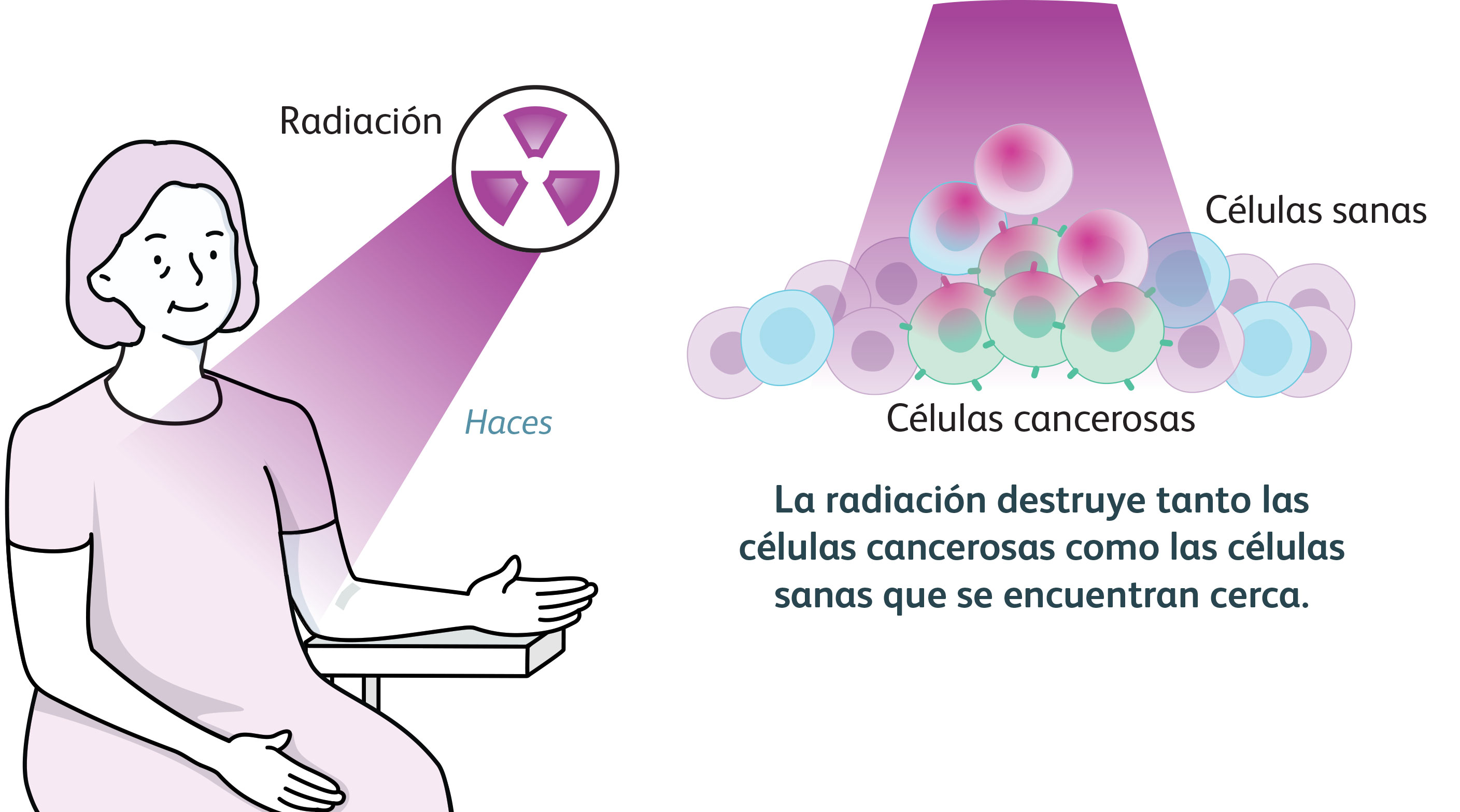 Ilustración que muestra a una mujer recibiendo radioterapia. La radiación destruye tanto las células cancerosas como las células sanas cercanas.